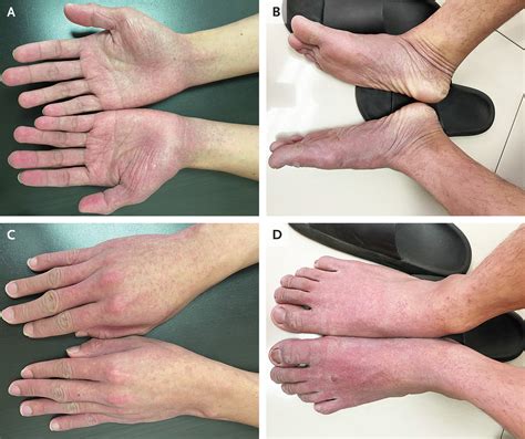 stocking glove syndrome|Papular purpuric gloves and socks syndrome